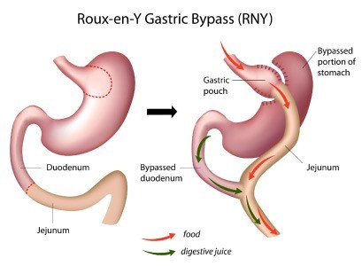 Roux-Y Gastric Bypass (žaludeční bypass s dvěma anastomózami)
