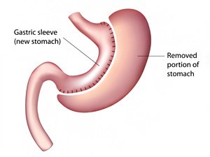 Tubulizace žaludku (sleeve gastrectomie)