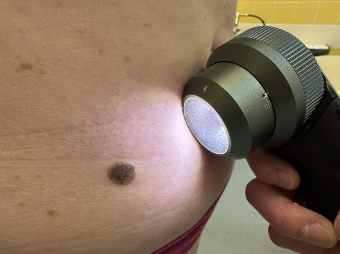 Závažná onemocnění kůže odhalila prevence. Den melanomu v Nemocnici Třebíč