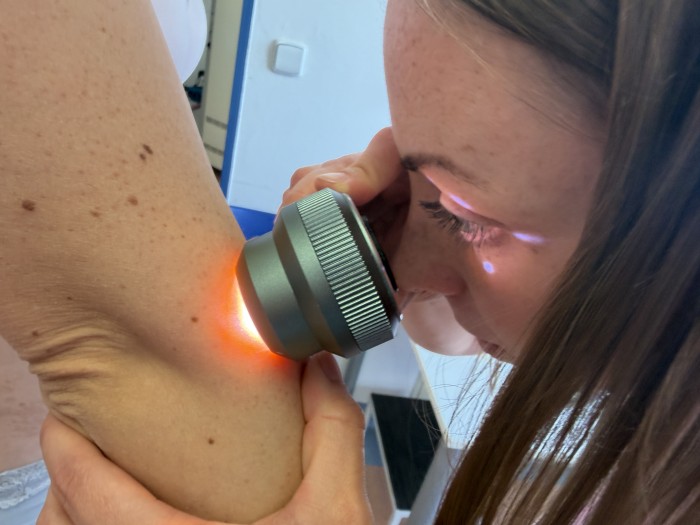 Evropský den melanomu připomněl důležitost prevence kožních nádorů